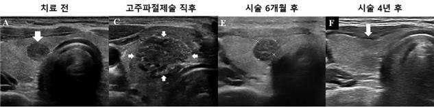 고주파절제술을 이용한 미세갑상선유두암 치료 과정 (출처=연합뉴스)