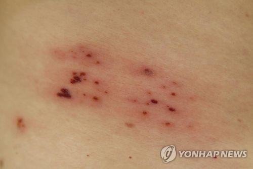 대상포진 (출처=연합뉴스)
