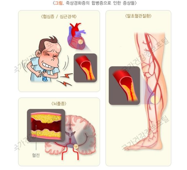 죽상경화증으로 인한 합병증. (그림=국가건강정보포털 제공) *재판매 및 DB 금지