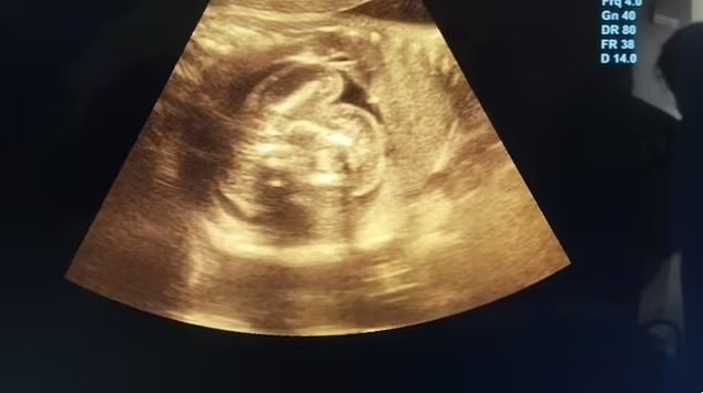 [서울=뉴시스] 태아 속 태아 현상이 나타난 초음파 사진이다 (사진=데일리메일 홈페이지 캡쳐) 2025.02.21.photo@newsis.com *재판매 및 DB 금지