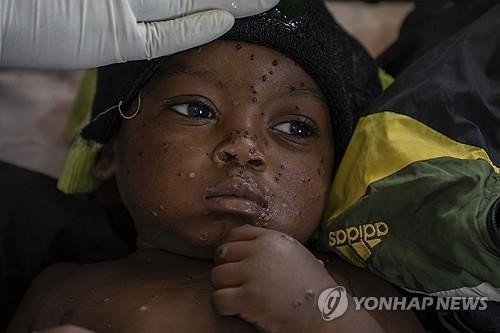 콩고민주공화국의 2세 어린이 엠폭스 환자 (출처=연합뉴스)