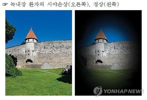 [위클리 건강] 초고령사회의 그늘 '녹내장'…"정기검진이 실명 막는 최선책" (출처=연합뉴스)