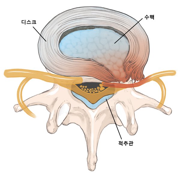 [서울=뉴시스] 7일 자생한방병원은 메이저 토토 사이트디스크와 비만의 상관관계를 홍순성 원장의 도움말로 소개했다. (사진=자생한방병원) 2025.03.07. photo@newsis.com *재판매 및 DB 금지