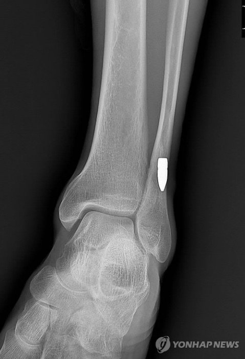 발목에 박힌 K2 소총 탄두 (출처=연합뉴스)