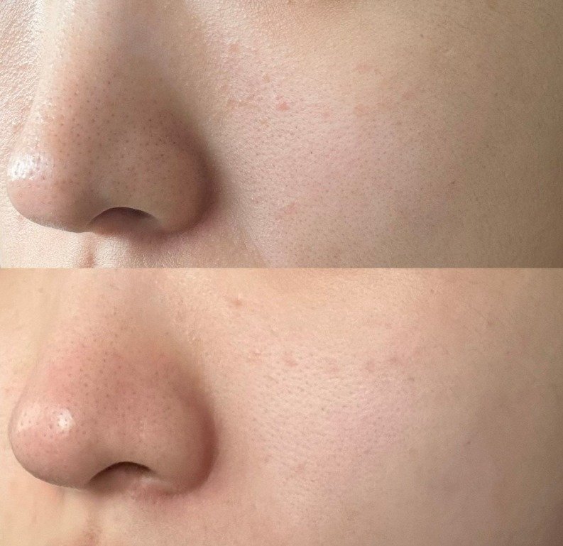 지샌달을 바르기 전(위)과 2주간 사용한 이후 피부 ⓒ News1 강은성 기자