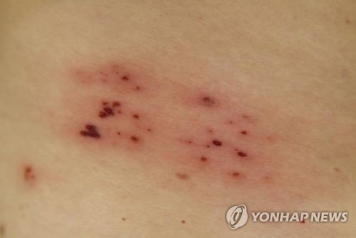 대상포진 (출처=연합뉴스)