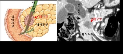 췌장암 CT 영상 (출처=연합뉴스)