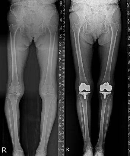 80세 여성 인공관절(pnk) 수술 전후. 연세사랑병원 제공