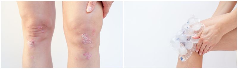 건선으로 피부에 각질이 생겼다. 가려움증이 생겼다면 긁지말고 냉찜질을 해주는 것이 좋다. 게티이미지뱅크