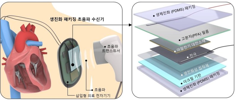 생체 친화 초음파 수신기 (출처=연합뉴스)