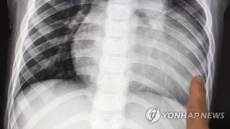 폐 엑스레이 (출처=연합뉴스)