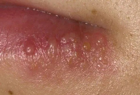노래방 마이크에 입대고 노래 불렀다가…'이 병' 감염된 여성