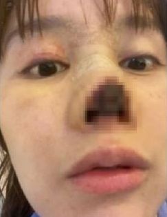 "코가 썩어들어간다"..코 성형 받았다가 5억원 날린 中여배우 [헬스톡]