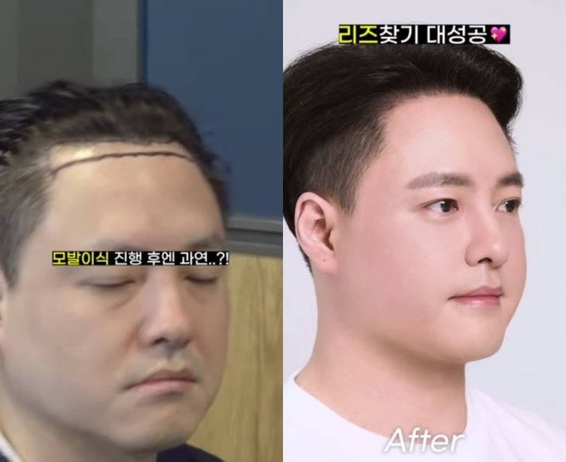 NRG 노유민, 모발이식 전후 공개…되찾은 리즈 비주얼 [N샷]