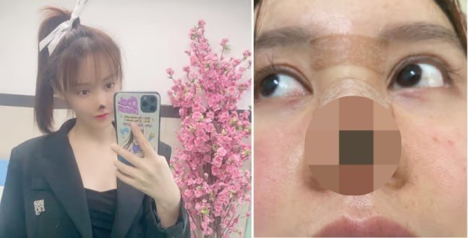[서울=뉴시스] 25일(현지시각) 영국 데일리메일 등 외신에 따르면 가오류는 지난 2020년 코 성형수술을 받은 직후부터 심각한 부작용에 시달렸다. (사진= 가오류 웨이보 갈무리 ) 2025.04.25. photo@newsis.com *재판매 및 DB 금지