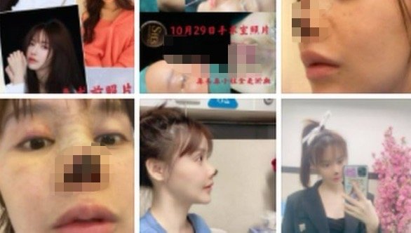 [서울=뉴시스] 25일(현지시각) 영국 데일리메일 등 외신에 따르면 가오류는 지난 2020년 코 성형수술을 받은 직후부터 심각한 부작용에 시달렸다. (사진= 가오류 웨이보 갈무리 ) 2025.04.25. photo@newsis.com *재판매 및 DB 금지