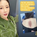 ′김태술과 6월 결혼′ 박하나, 등에 큰 화상 상처 