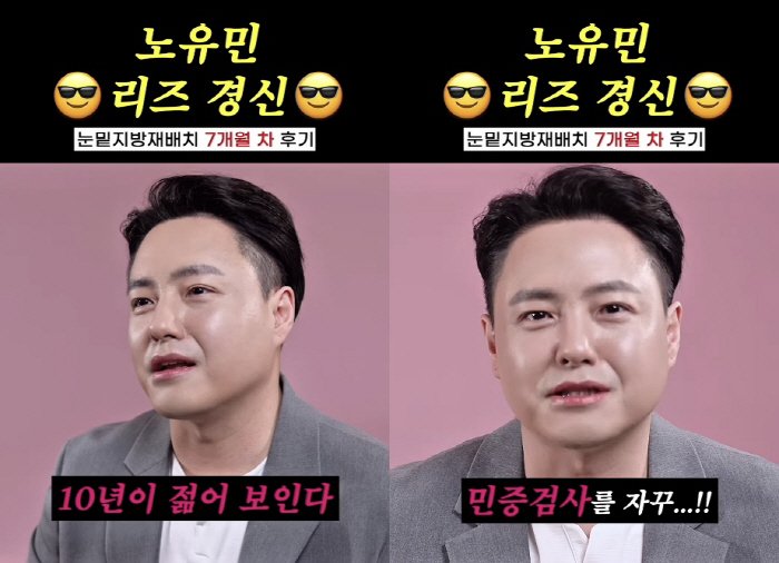 노유민, 눈 밑 '지방 재배치' 리즈 경신 "민증 검사 받아"