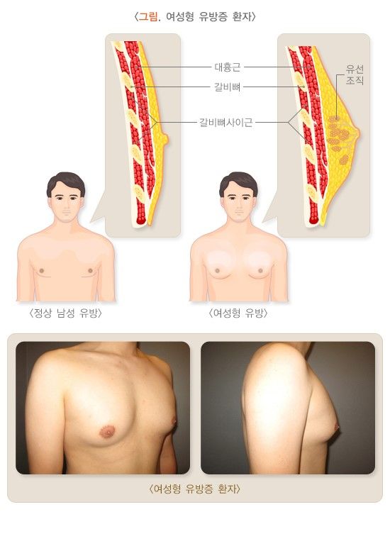 남성에게 에스트로겐이 과잉일 때 나타나는 증상은? [안철우 교수의 호르몬 백과사전]