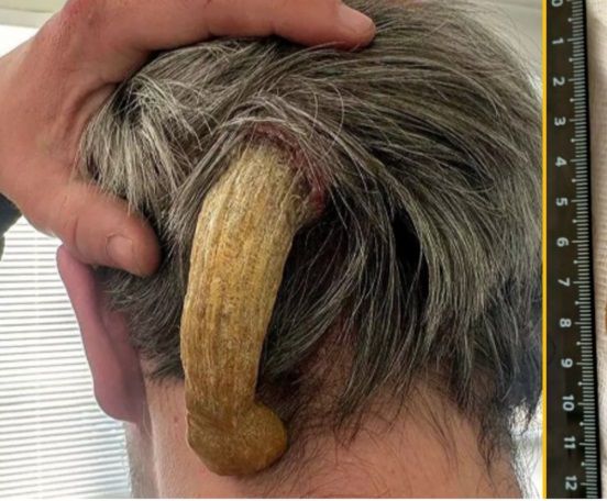 3년만에 13cm 길이로 자란 '머리 뿔'..30대男의 황당한 사연  