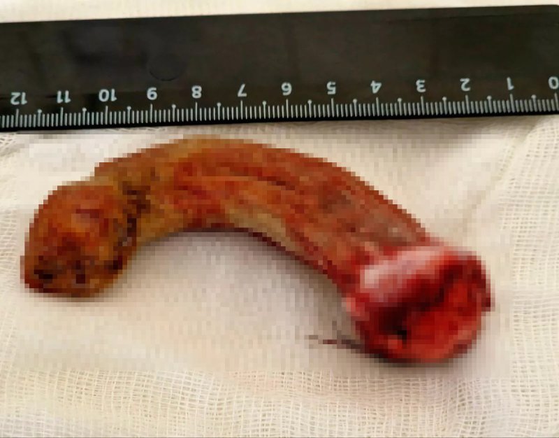 [서울=뉴시스]각질종. (사진=영국 매체 '데일리 미러' 캡처) *재판매 및 DB 금지