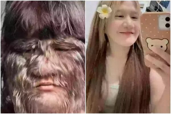 '늑대소녀' 20대女, 털 싹 제거…치료법은  