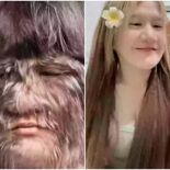 ′늑대소녀′ 20대 여성, 털 싹 제거…치료법은