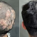 ′빨간 물집′ 생기더니 탈모…20대男, 무슨 병이길래