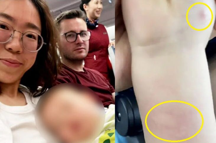 1살 아기 다리의 '이 자국' 때문에 비행기 탑승 거부됐다, 무슨 일?