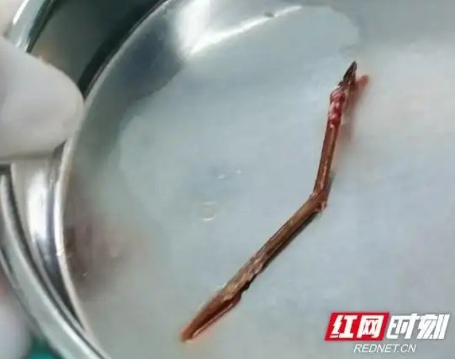 "기침 안 멈추더니…" 폐에 박힌 이쑤시개 '충격'