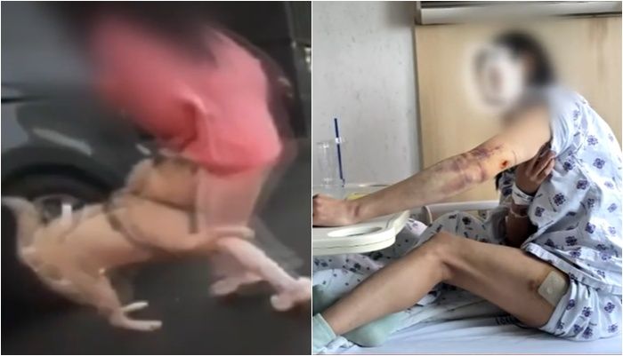 진돗개에 팔·허벅지 물린 예비 신부…견주는 "뼈라도 부러졌냐" 뻔뻔