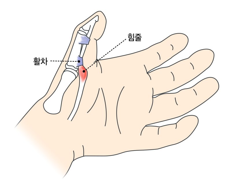 [서울=뉴시스]컴퓨터와 스마트폰 사용 시간이 크게 늘면서 바카라사이트 제작을 구부렸다 펴는 과정에서 통증이 생기는 '방아쇠 손가락(수지)' 환자가 증가하고 있다. 손가락을 구부릴 때 총의 방아쇠를 당기는 것처럼 삐걱거려 이런 이름이 붙여졌다. 엄지 등 손가락과 손바닥 사이 관절에 통증이 있고 아침에 증상이 유독 심하다면 방아쇠 손가락이 아닌지 의심해 볼 필요가 있다. (이미지= 강동경희대병원 제공) 2025.05.27. photo@newsis.com.