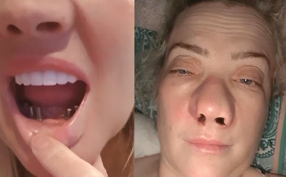 영국 텔퍼드 거주 리안느라는 이름의 여성이 소셜미디어(SNS)에 올린 사진. 그는 비싼 영국 치과 치료비를 피해 터키에서 온라인 바카라사이트 추천 온라인 바카라사이트 추천을 받았지만 1년째 극심한 후유증에 시달리고 있다고 호소했다. 틱톡 캡처