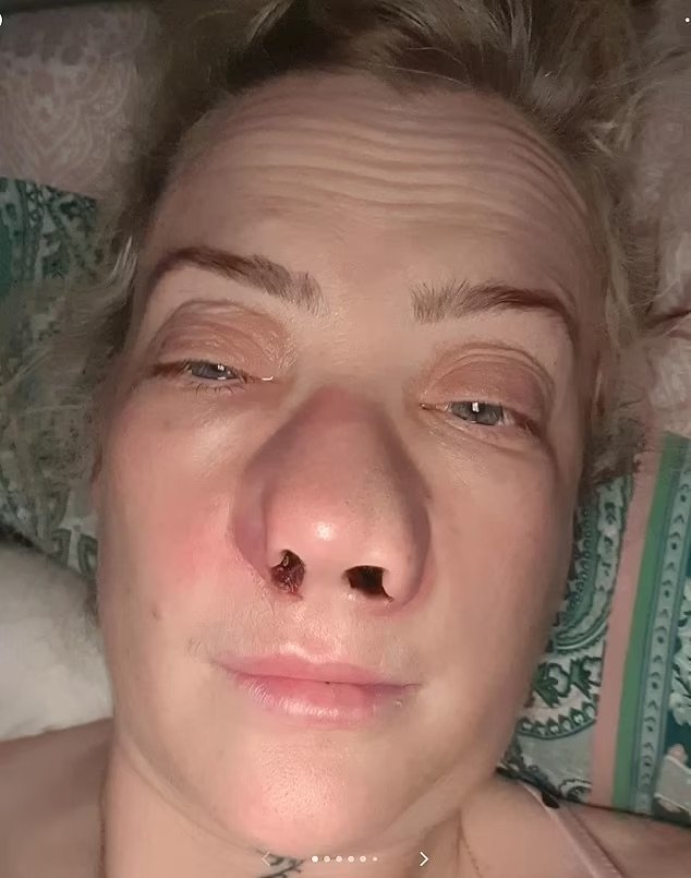 저렴한 비용에 혹해 해외로 간 여성… 돌아온 뒤 얼굴 망가졌다