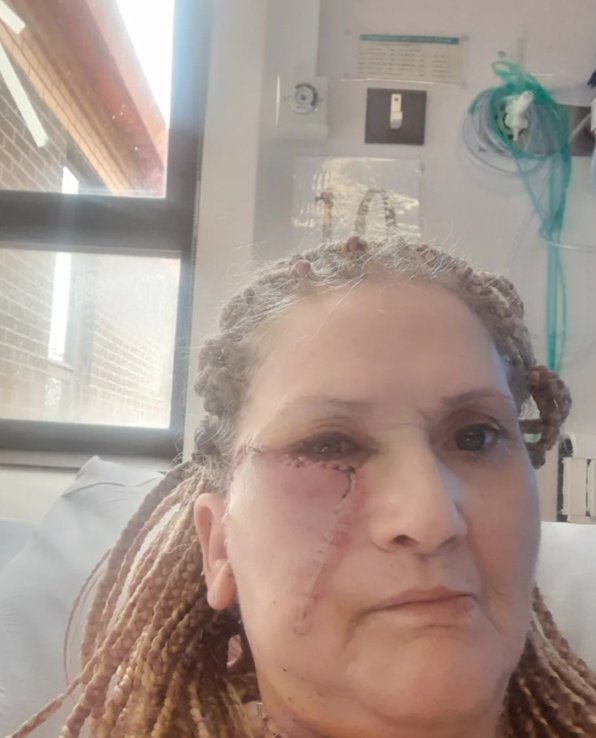 [서울=뉴시스] 웨일스 스완지에 사는 자넷 토마스(63·여)는 피부암 수술을 위해 오른쪽 볼와 목을 절제하는 수술을 하고 150 바늘을 꿰멨다. (사진=더선 캡처) 2025.05.29 *재판매 및 DB 금지