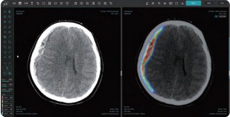 [서울=뉴시스] 29일 의료기기 업계에 따르면 인공지능(AI) 기반 뇌질환 카지노사이트 바카라사이트 기업 제이엘케이(JLK)가 개발한 ‘JLK-SDH’ 솔루션이 미국 식품의약국(FDA)으로부터 인허가를 획득한 것이 재조명되며 주목받고 있다. (사진=제이엘케이 제공) 2025.05.29. photo@newsis.com *재판매 및 DB 금지