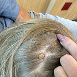 진드기 한 마리에 마비까지…캠핑 후 벌어진 4세 여아의 악몽