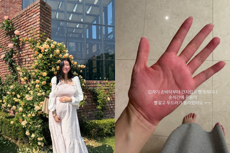 '쌍둥이 임신' 김지혜, 항생제 부작용으로 응급실…"온 몸이 빨개져"