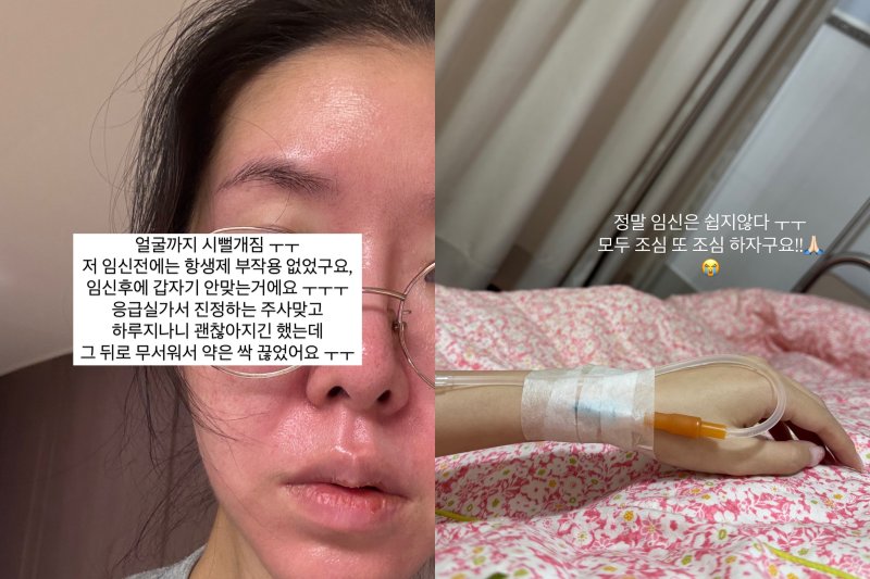 '쌍둥이 임신' 김지혜, 항생제 부작용으로 응급실…"온 몸이 빨개져"