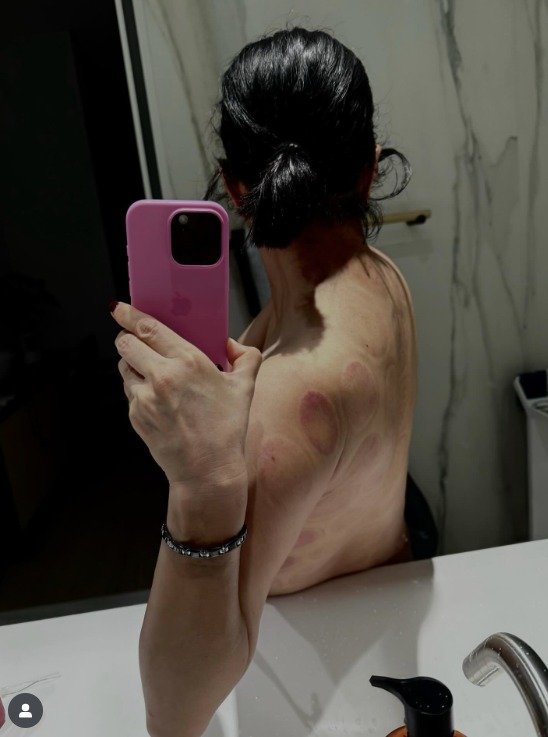이혜영, 상의 완전 탈의 모습 공개…이유는? 선명한 부항 자국 [N샷]