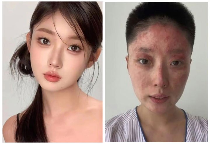 [뉴시스] 중국의 한 SNS 뷰티 인플루언서가 사고로 전신에 화상을 입은 모습을 공개했다. (사진=지무뉴스, 다허바오 편집) 2025.05.30
