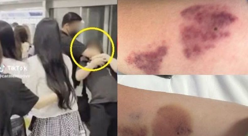 "어깨 부딪혔다고 짐승 다루듯 진압"..걸그룹 경호원에 폭행당한 피해자, 충격 사진 공개