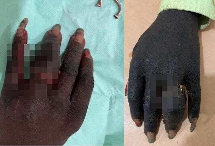 "손가락 잘릴뻔했다"…20대男, 반지 꽉 끼어 결국 절단기로 빼내 [헬스톡]