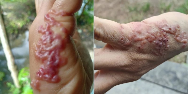 "손에 물집 생겨 병원 갔는데…" 피부 속 자리한 '이것'에 경악