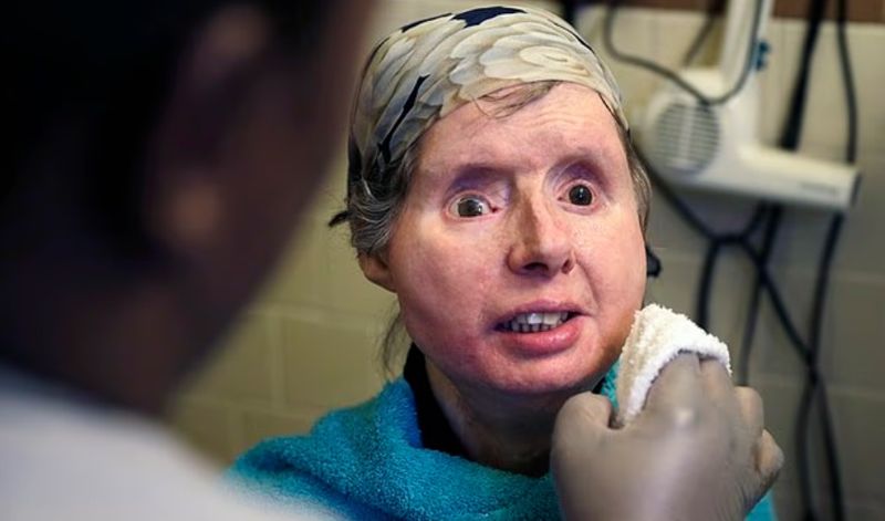 침팬지에 공격 당해 얼굴 잃었던 女, 16년 만에 깜짝 근황 공개