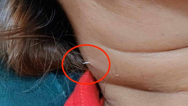 [뉴시스] 태국에서 40대 여성이 식사 중에 삼킨 생선인기있는바카라사이트가 목을 관통해 피부 밖으로 돌출됐다. (사진=페이스북) /사진=뉴시스