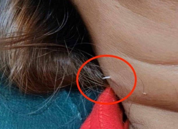 무심코 삼켰는데 목 뚫고 나온 생선가시..절대 하면 안되는 행동은  
