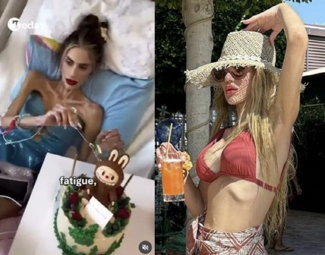 30대 유명 인플루언서 사망…'몸무게 23kg' 거식증 영향