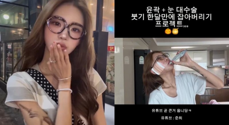 최준희, 퉁퉁 부은 얼굴에 붕대 칭칭 "윤곽+눈 대수술…"