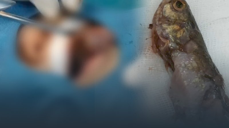 베트남에서 4살 남자아이가 살아 있는 민물고기를 목에 삼키는 사고가 발생해 긴급 수술을 받았다. 출처 : tuoitre *재판매 및 DB 금지
